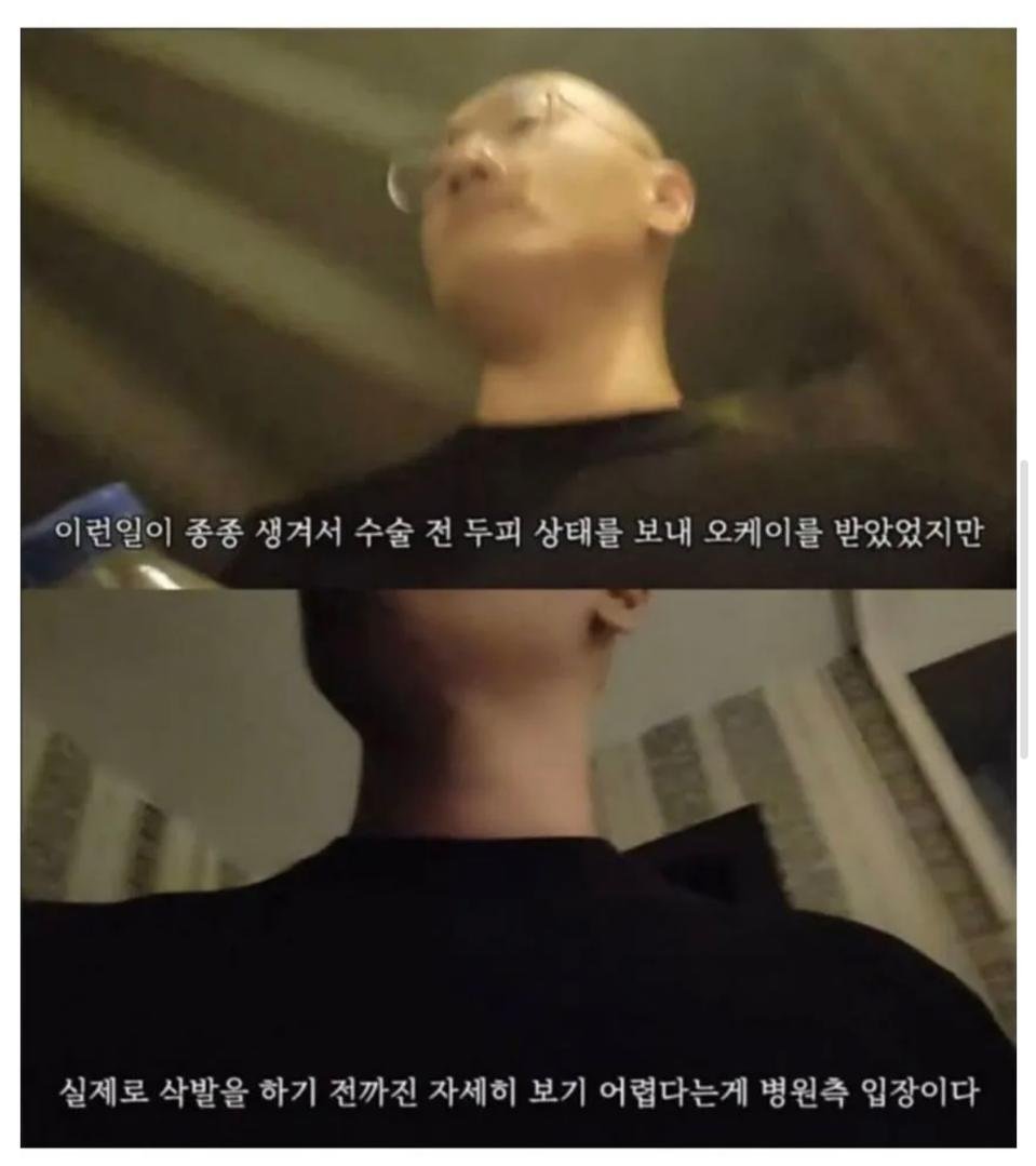 터키로 모발이식 받으러간 남성2