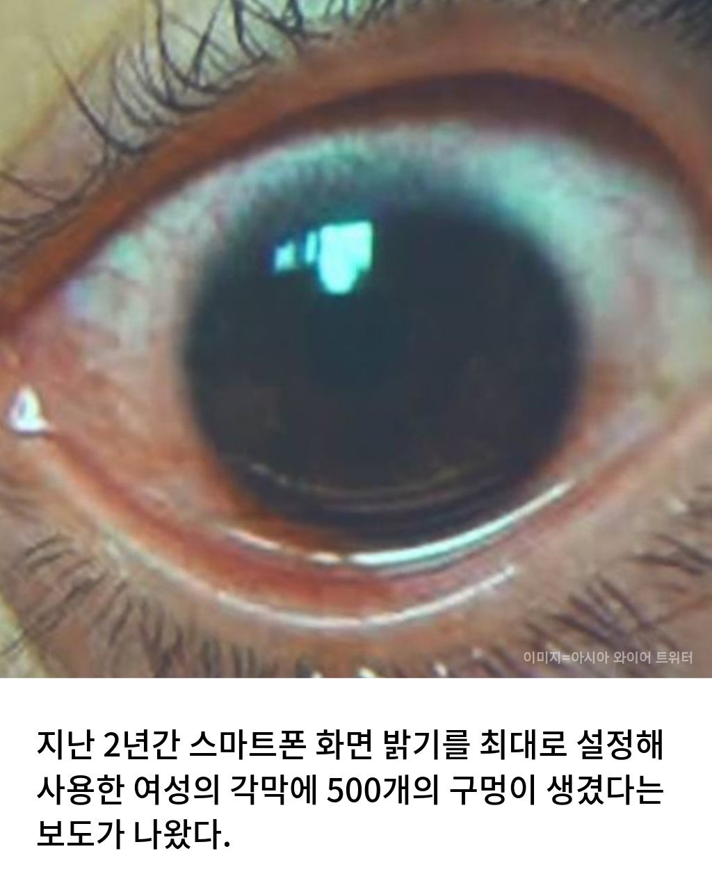 스마트폰 최대 밝기로 보다가 각막에 구멍남2