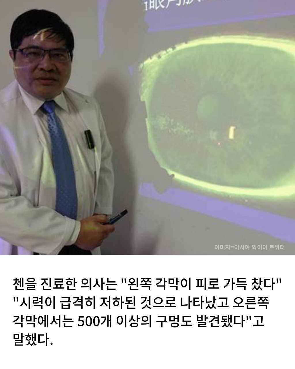 스마트폰 최대 밝기로 보다가 각막에 구멍남5